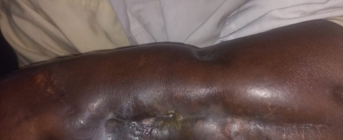 ساهمت منظمة جوجو الجنوبية في تقديم الدعم الإنساني لمواطن سوداني كبير في السن يعاني من كيس دهني في الورك، وذلك بمدينة الكلاكلة، بتاريخ 30/7/2026.
